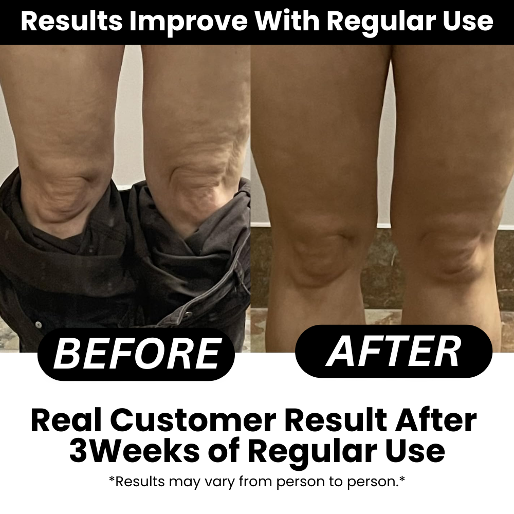 SmoothRise™ Anti-Cellulite Massage Roller