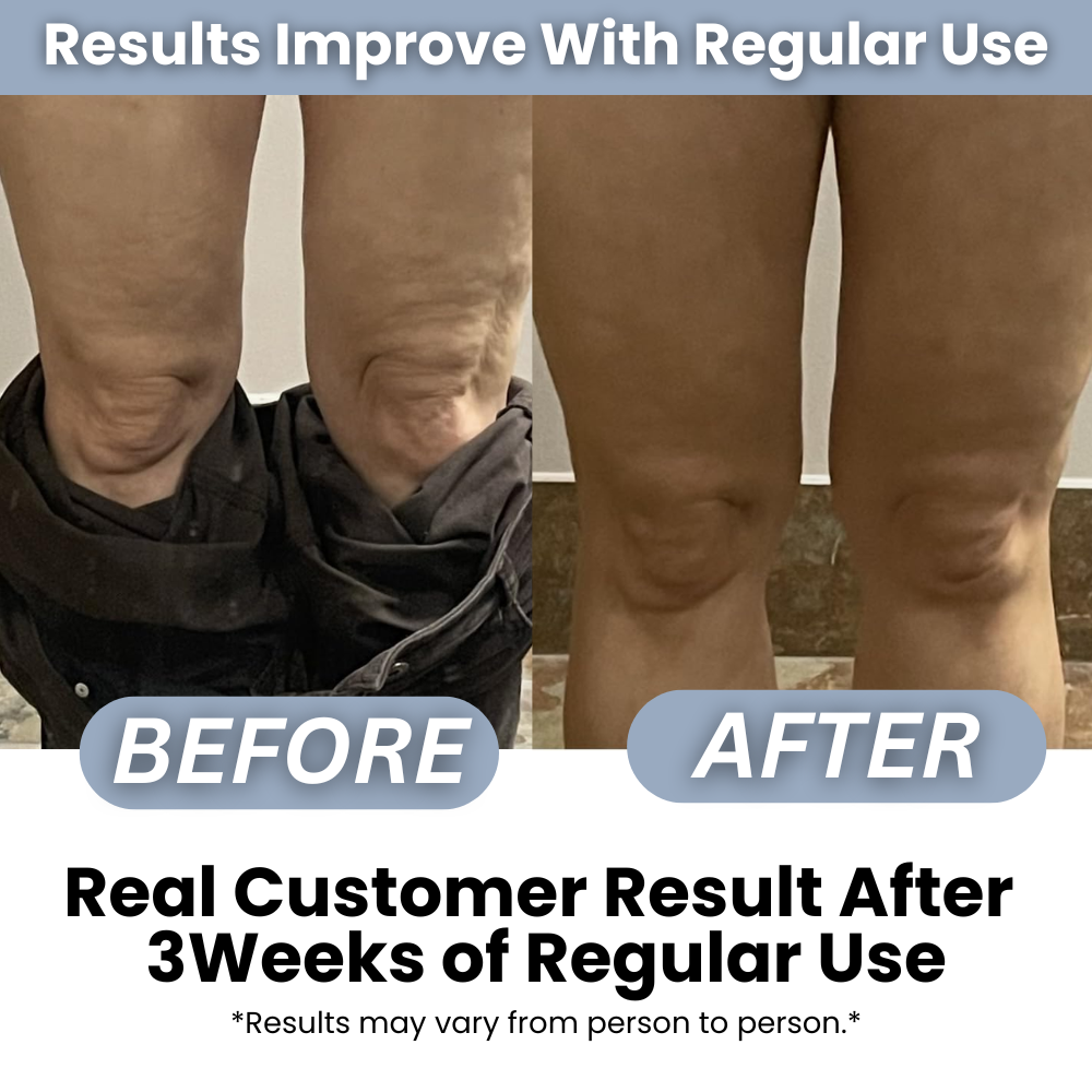 Anti Cellulite Roller + Massage Oil Kit